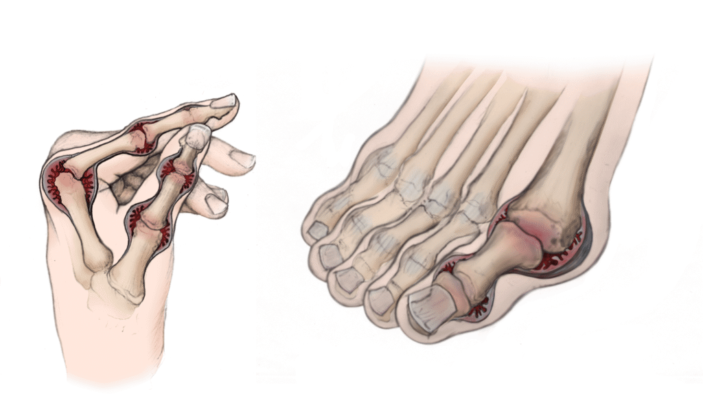 Rheumatoid Arthritis