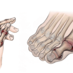 Rheumatoid Arthritis