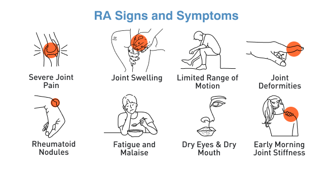 symptoms of Rheumatoid Arthritis