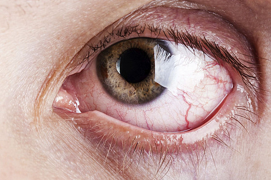 Causes of Itchy Dry Eyes