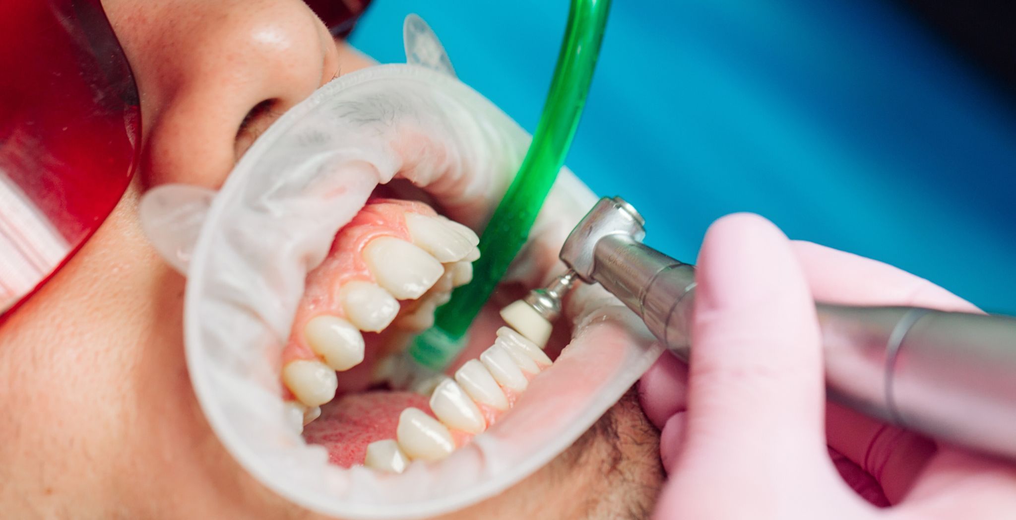 Dental Cleanings