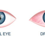 Dry eye syndrome