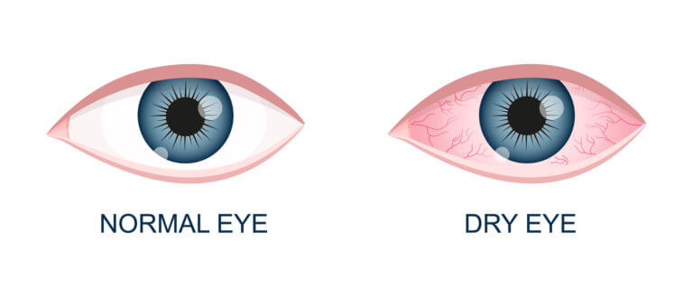 Dry eye syndrome