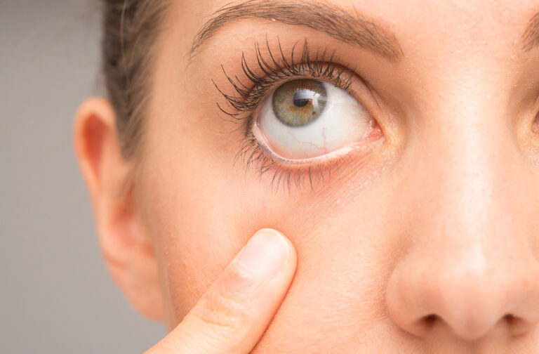 Benefits of Omega-3 Fatty Acids for Managing Dry Eye