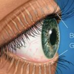 Meibomian Gland Dysfunction