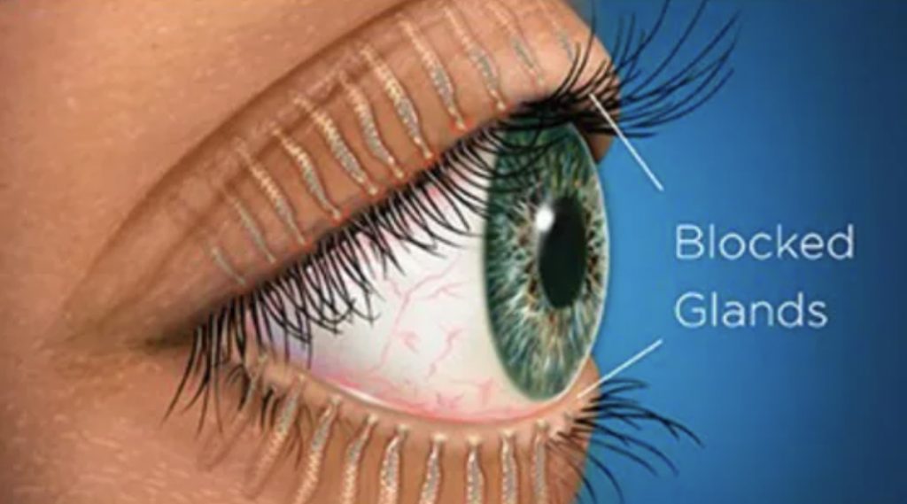 Meibomian Gland Dysfunction