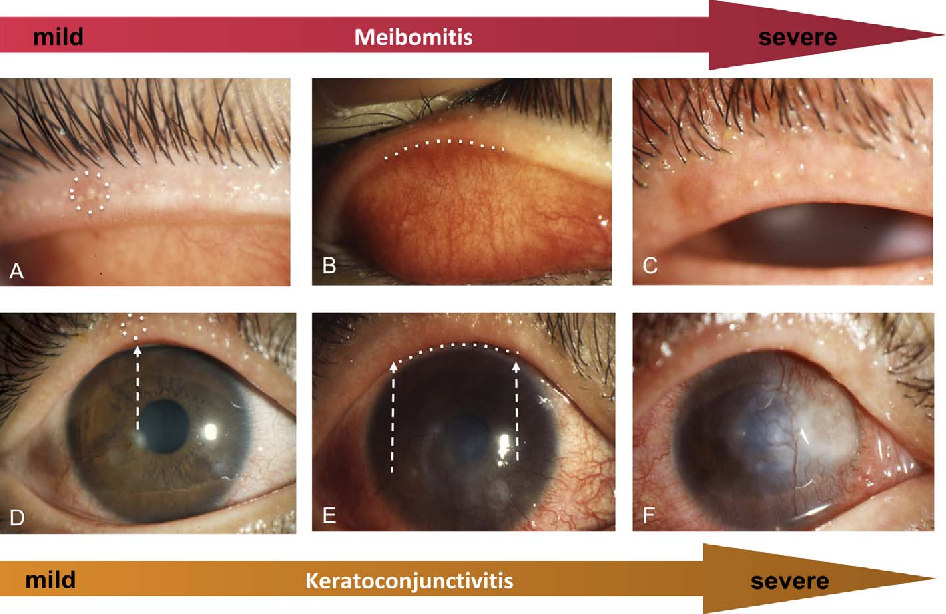 Meibomian Gland Dysfunction