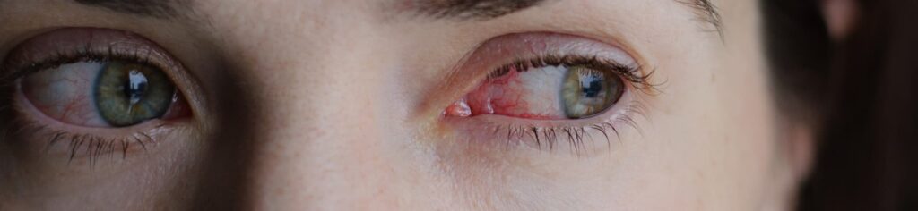 Symptoms of Meibomian Gland Dysfunction