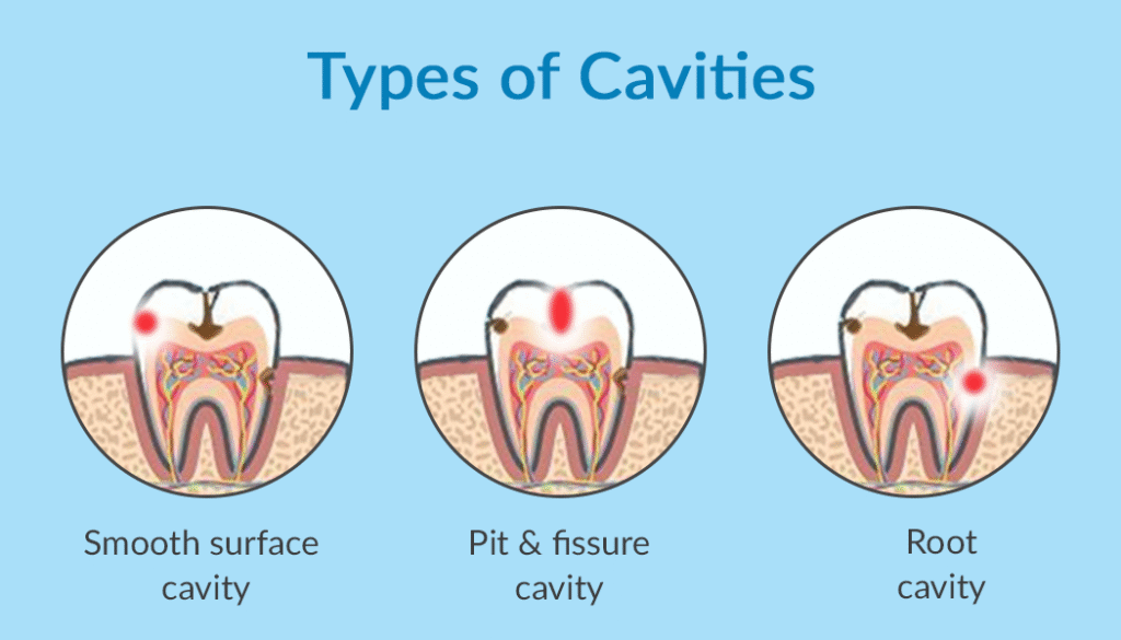 Cavities and Their Causes