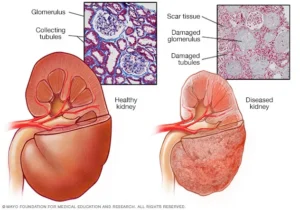 Chronic Kidney Disease
