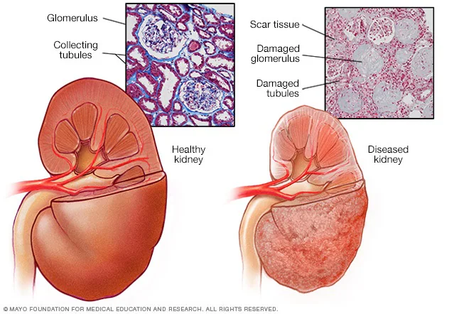 Chronic Kidney Disease