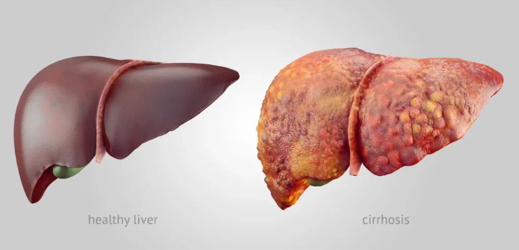 How Alcohol Damages the Liver