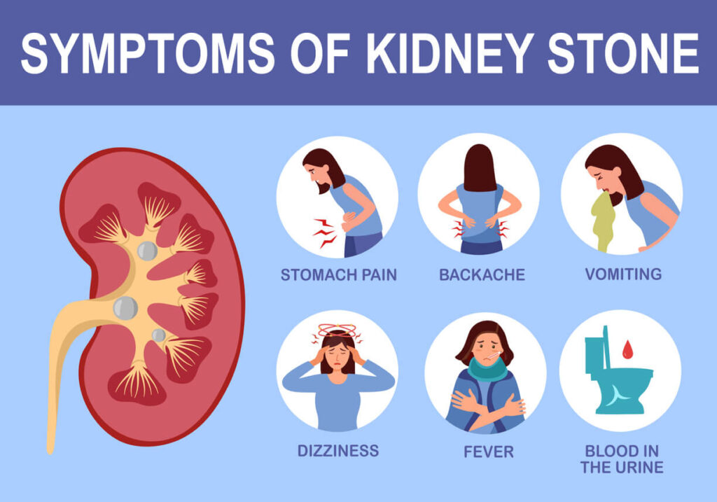 symptoms of kidney stones
