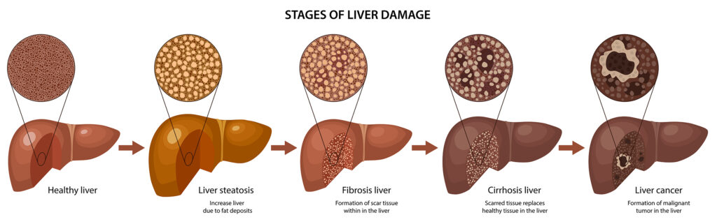Stages of Liver Disease