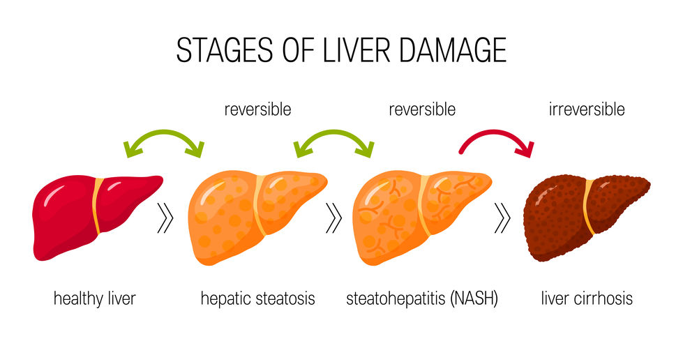 Liver Disease in Diabetes