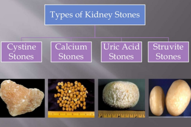 Types of Kidney Stones