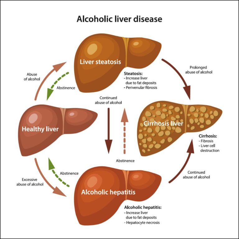 Role of Alcohol in Liver Disease