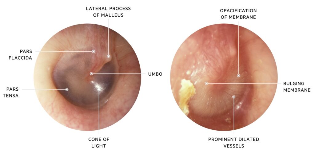 Acute Otitis Media
