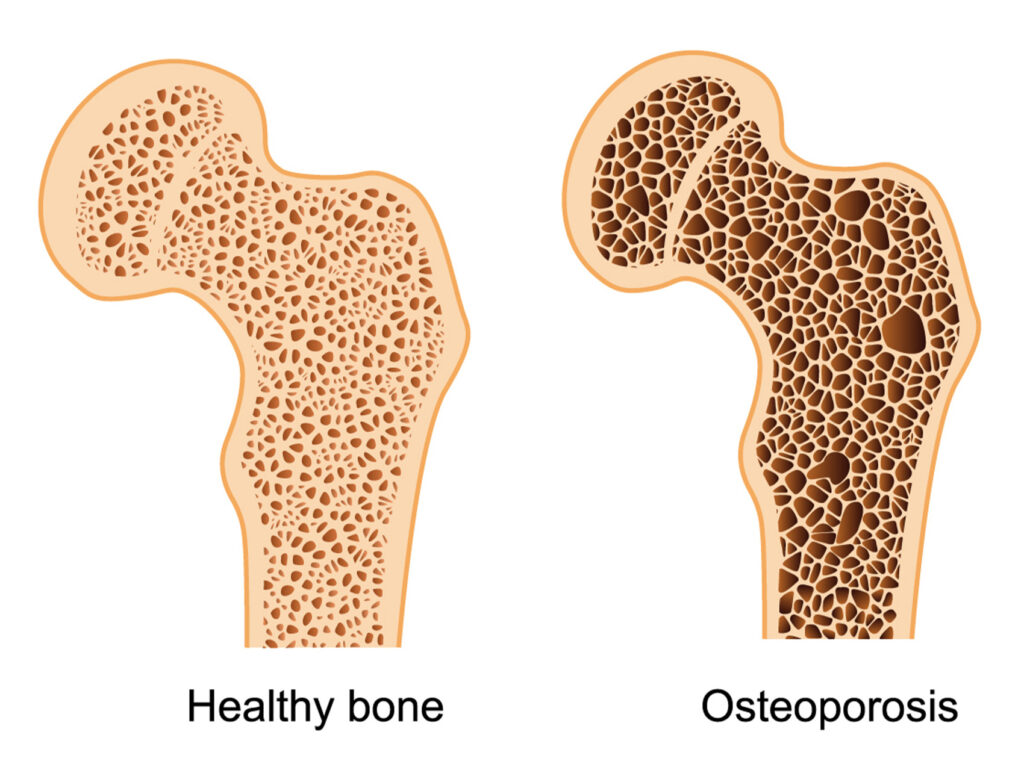 Bone Density and Osteoporosis