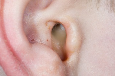 Ear Infection